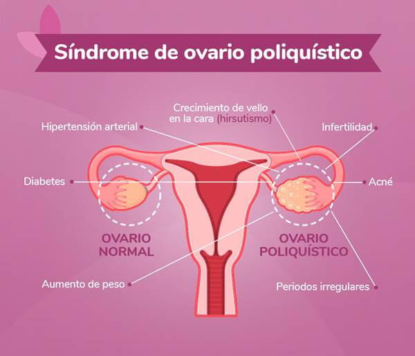 Imagen del sistema reproductor femenino