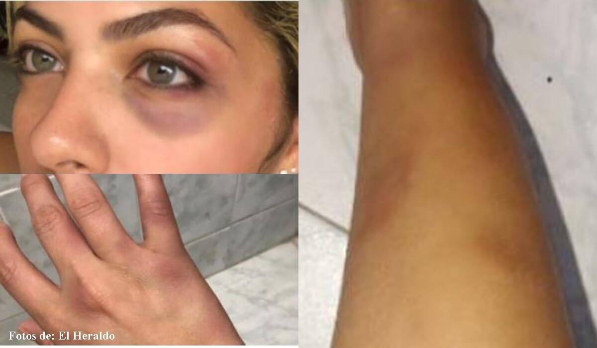 Heridas de Laura Ojeda en la cara, mano y pierna