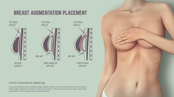 Infografía que ilustra cómo pueden ponerse los implantes mamarios